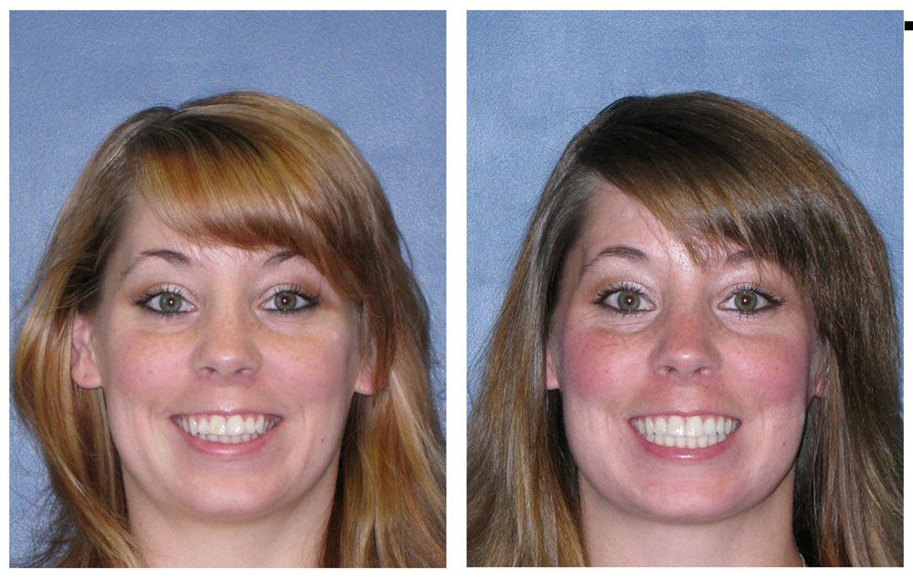 Invisalign Before & After