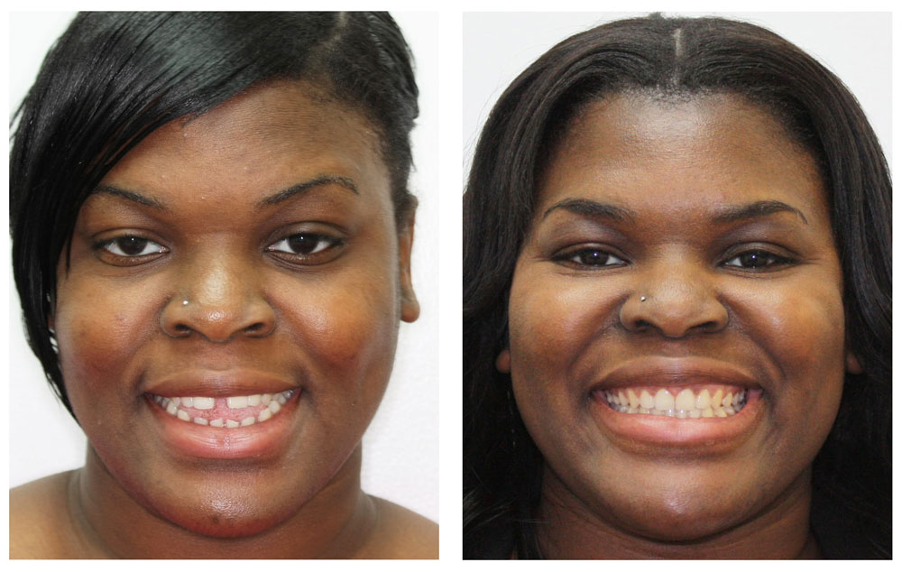 Invisalign Before & After