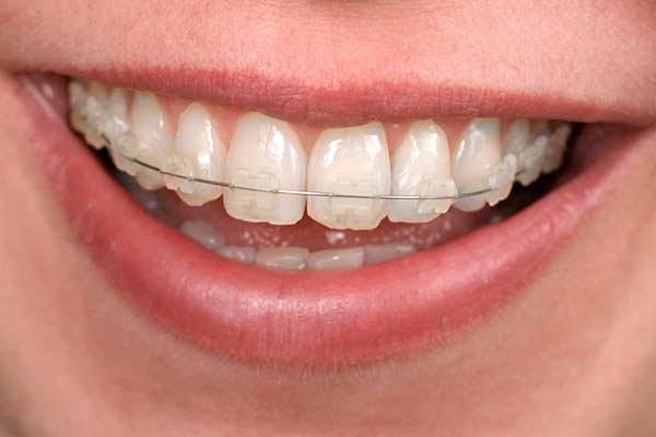 Clear Braces: What Are They? - Oak Tree Dental Ashburn Virginia