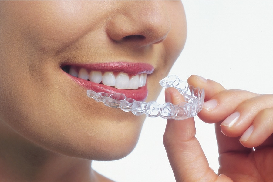 Clear Aligners Photo