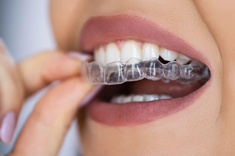 Clear Aligner Treatment Timeline from Start to Finish