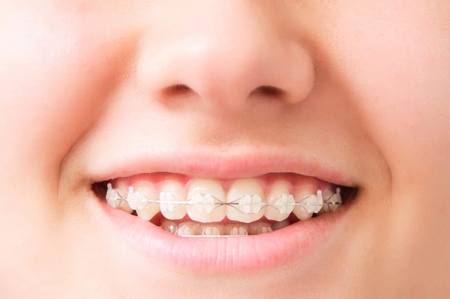 How to Keep Your Clear Braces Looking Invisible