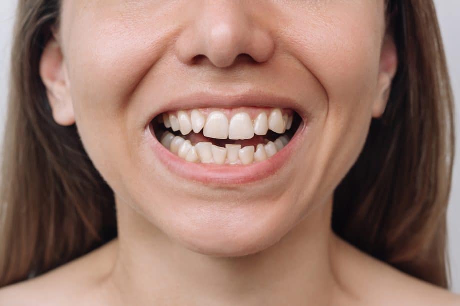 Is It Too Late to Fix My Crooked Teeth?