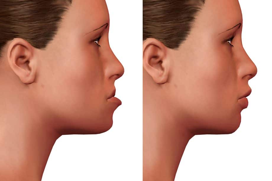 Preparing for Orthognathic Surgery What Iowa City Patients Should Know