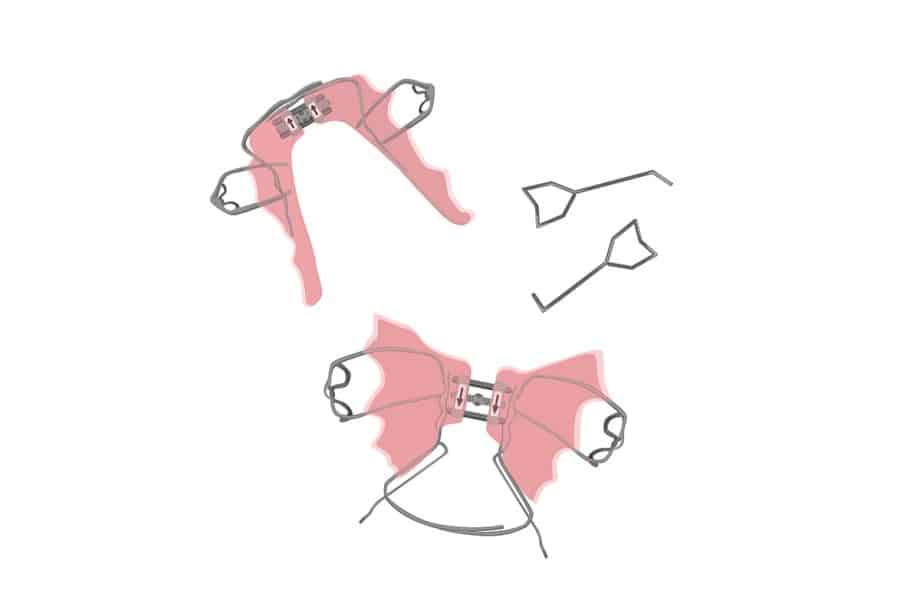 What You Need to Know About Palatal Expanders for Teens